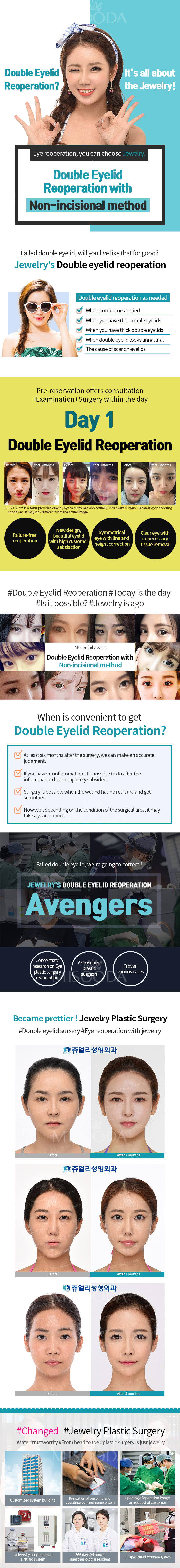 Tái phẫu thuật mắt hai mí (phương pháp không mổ)