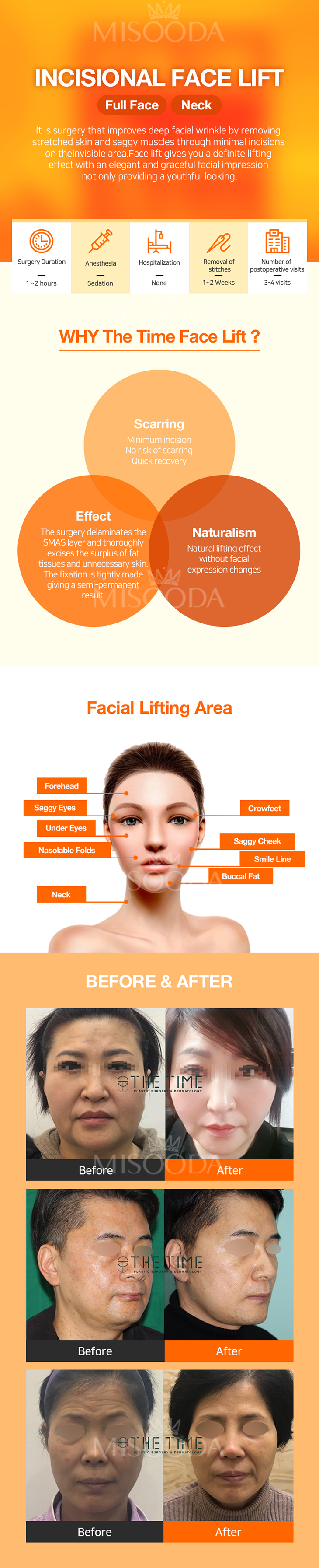 Incisional Face Lift