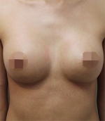 breast