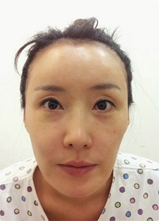 下巴+双眼皮再手术，激光溶脂提升，脂肪移植