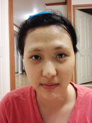 Eyes, Nose, Fat Transfer Experience at ITEM PS in Korea