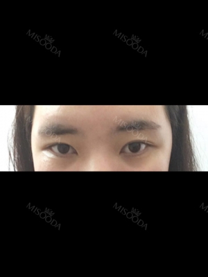 Incisional Double Eyelid & Upper, Lateral Cantho Plasty