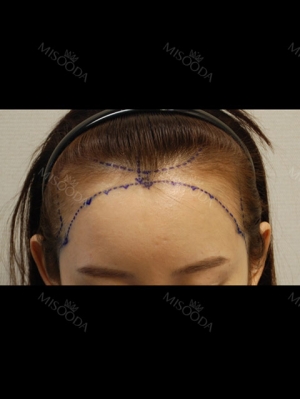Hairline transplant surgery (after 7 months)