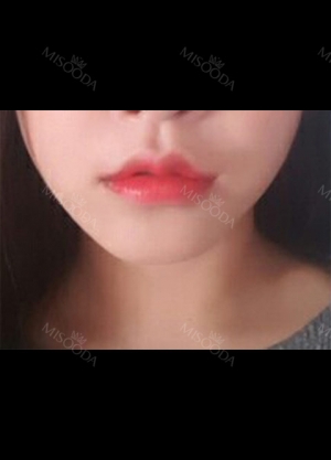 I had Smile lip lifting, Cupid’s bow lip and lip tubercle surgeries in Hyundai Aesthetics