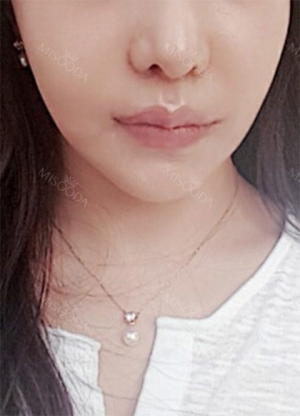 Philtrum Reduction, Lovely Smile Balanced, Cupid’s bow lip Surgery