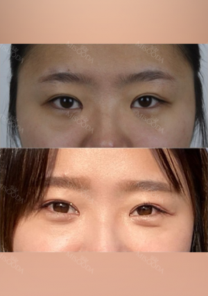 Double eyelids revision : 2 weeks at Wonjin!