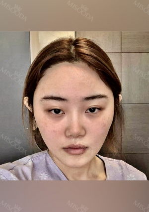 Facial Contour + Revision Nose Surgery