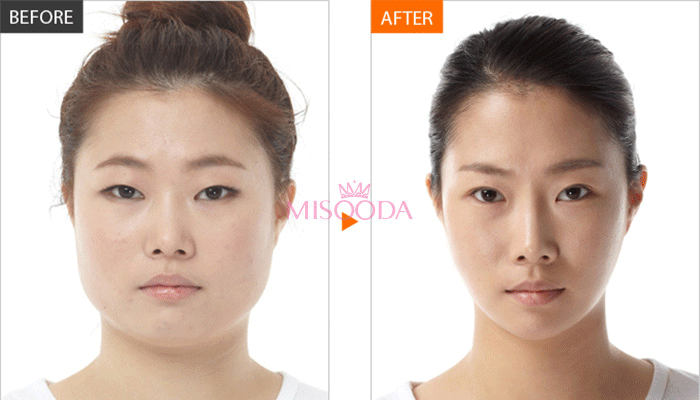 Korea eye surgery before and after — MISOODA verified patient