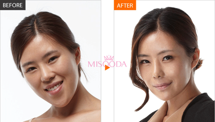 Korea liposuction contouring before and after — MISOODA verified patient