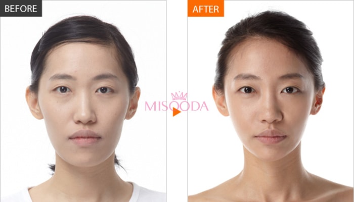 WHY Korean Two Jaw Surgery or Double Jaw surgery is popular? Guide ...