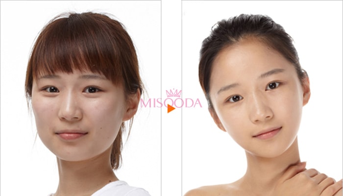 cheekbone rediction surgery in korea