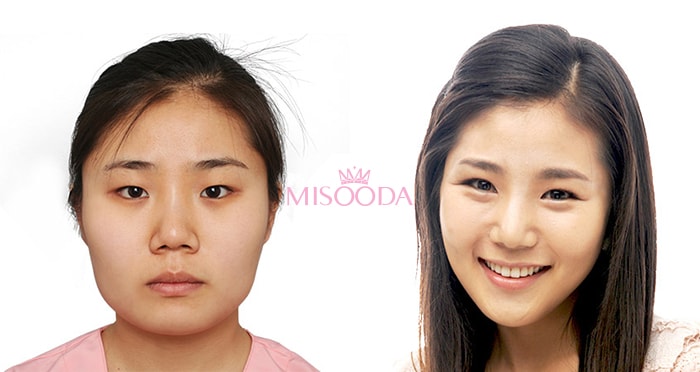 WHY Korean Nose Surgery? Guide, Reviews, Images, Promotions | MISOODA