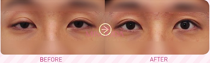 WHY Korean Ptosis Correction Eyelid Surgery is different Guide