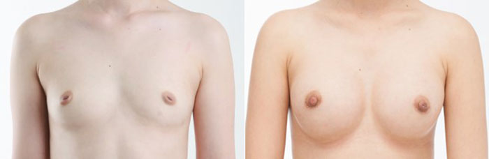 Nipple Surgery (Inverted, Protruding, Areola)