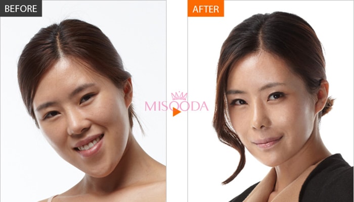 Why Korean Facial Contouring Surgery Guide Reviews Promotions Misooda