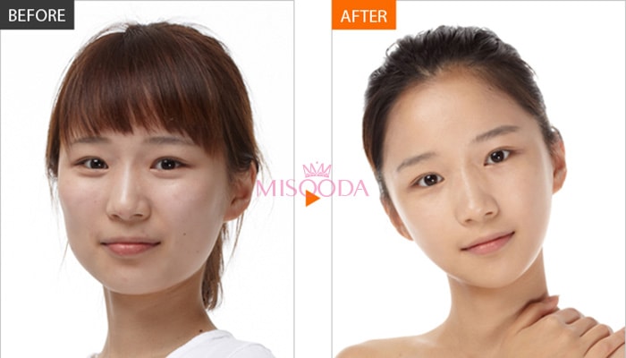 Korean Plastic Surgery Ensuring Safe and Sleek V-Line Facial Contouring  Surgery