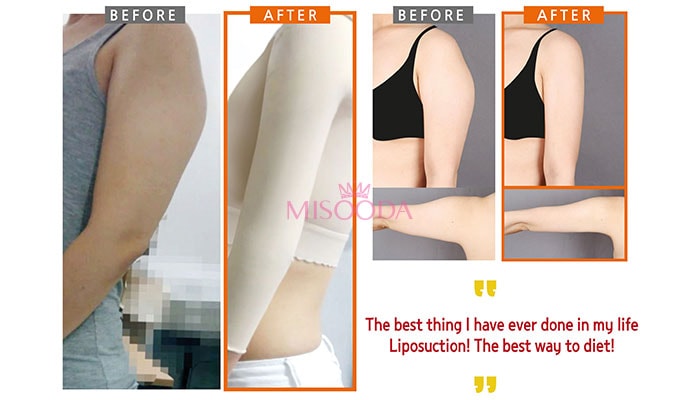 Lienjang Body Liposuction – Lienjang Plastic Surgery Dermatology Korea