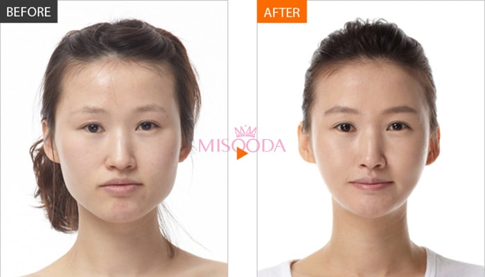 WHY Korean Facial Contouring surgery? Guide, Reviews, Promotions