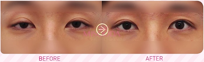 Why Korean Double Eyelid Surgery Guide Reviews Promotions Misooda