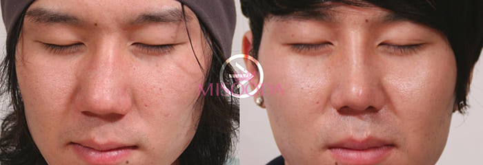 Why Korean Nose Augmentation Bridge Tip Guide Reviews Promotions Misooda