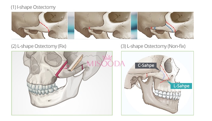 types of cheekbone reduction surgery in korea