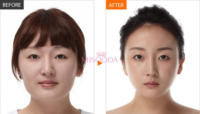 zygoma reduction surgery in Korea