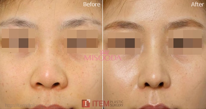 Why Korean Rhinoplasty Alar Reduction Method Reviews Promotions Misooda