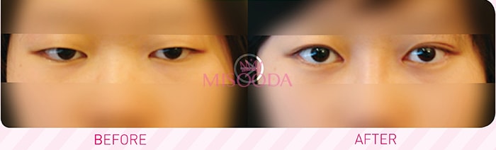 Ptosis correction shop