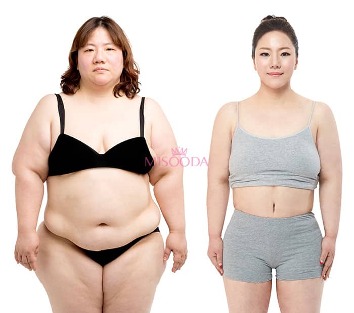 Full Body Liposuction Korea, Korean Full Body Liposuction Costs