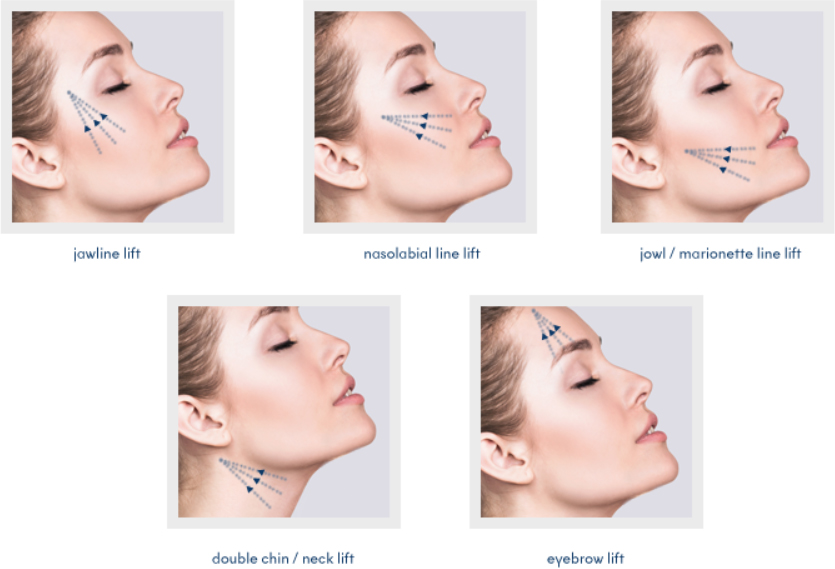 Semi-Invasive Face Lift: Thread Lift (MINT, OMEGA, Blue Rose TL)