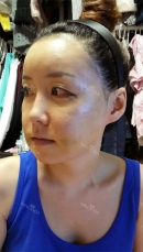 Post OP 4 days.. Still swelling.. However compared to before.. my cheeks are in better shape! There wasn't any problem to EAT something!! I really had a hard time, it almost felt like extreme diet to me!
doctor said the operation had been successfully done