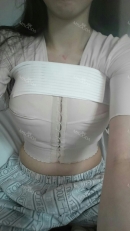 Before the surgery, my breast was totally flat. I was 160cm, 47kg, 76cm and 80cm of my lower and upper bust size. But after I took off the bandage and measured my breast, the lower and upper bust size was 72cm and 84cm.

At the follow up, the doctor said when the upper swelling will naturally come down, my breast will be prettier.

The doctor asked me “Was it painful after the surgery?” and I answered it wasn’t painful at all. He said it was because of his great skill. There was full of laughter in the room. 

I purchased some bras and 70 D or 70C perfectly fits on me. I’m so happy that I have a C cup breast. 

My husband said he should have let me taken the surgery faster because I’m so satisfied with my breast whenever I look in the mirror. The texture got better after one month and I’m satisfied when I touch my breast. 

After my confidence increased, there is no marital problem anymore and I fell into buying bras.

Now I don’t remember my original appearance and it seems like my breast that I have now is my original breast.