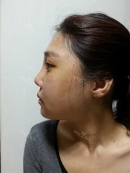 Swelling and bruising start goes down rapidly after the 5th day, and stitches are removed as well (Rhinoplasty).