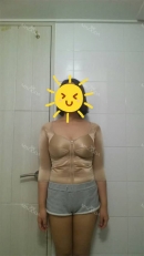 Hello. this is my review a month after surgery.
i still wear compress wear to get my body in the shape.