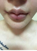 The wound got much better on my lips but the healing depends on each individual because everyone has different recovery speed. The clinic mentioned that recovery can be between 20 days to up to 6 months. Thankfully for me, I wore make up and lipstick after 1 month and now it I can hardly see any scarring!