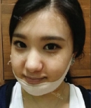 after surgery, my face so swollen and looks bigger than before. But not that big than I thought.