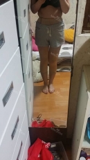 　一週間前に脂肪吸引術を行いました。 脂肪吸引後1ヶ月までは圧迫服を着用しなければなりませんでした。 ご覧のように切開部位から少し液体が出ています。これは特に心配する必要なく、正常な症状ということで、手術後1週間または2週間後に止まるということです。