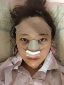 Hello~ this is my a week after surgery review.
there is nothing special except my happy feeling because i felt my nose become different. eventhough the shape not  perfect yet because of swollen. but it doesnt matter. i can do my activity like a normal except i can't do hard excersice as the doctor didn't recomend me to did that.