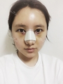 Hello~ this is my a week after surgery review.
there is nothing special except my happy feeling because i felt my nose become different. eventhough the shape not  perfect yet because of swollen. but it doesnt matter. i can do my activity like a normal except i can't do hard excersice as the doctor didn't recomend me to did that.