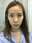 Jaw Reduction, Rhinoplasty and Breast Augmentation in Korea