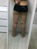 Thigh Liposuction+Calf Botox