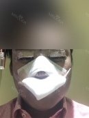 The operation was done in two phases: eyes followed by nose. I had to be awake during the surgery for my eyes as they needed me to open and close my eyes during the surgery. Once the eyes were done, I was sedated, and rhinoplasty was conducted. There were instances of discomfort for lateral canthoplasty but other than that, everything else was a breeze. I even woke up from the operation wondering if they forgot about my rhinoplasty. 
I had a friend to take me back to my hotel after the operation. She helped me settle the medication purchases and instructions. I believe most people will be able to make their way back on their own, but I certainly recommend at least a pick up. 
Post-operation looks like that: 
Post-op did not hurt but was mildly uncomfortable. I was asked to return the next day to remove some of the bandages.