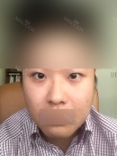 Operasi Hidung (tulang rawan telinga, silikon), Koreksi Ptosis dan Canthoplasty Lateral.