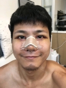 It’s been nearly 2 weeks after my surgery to my eyes and second nose surgery. Before, the implant shifted making my nose look bent to the right so decided to have my nose again. My eyes were the typical Asian eyes or a button eyes; it didn’t stand out and wasn’t that big either so I decided to do my eyes together. Here’s 4 days after; 10 days after; 2 weeks after