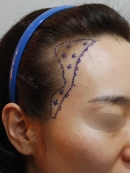 My Hairline Hair Transplant Surgery in Yonsei Hair Transplant clinic