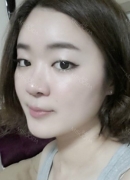 After the swelling went down, the grafted fat remained in my face. I totally loved the effect! Could not have imagined someone so slim to have such a cutesy chubby face