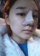 On the second day after the operation, there was slight swelling but it wasn’t as bad as I expected. I went to the clinic for wound dressing and removed that cotton gauze that made my breathing difficult the night before.