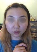 Eye, Nose, Facial contouring at View