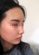 This is my 1 month post rhinoplasty and fat grafting. Major of my swelling, swelling and red eye is gone, and no pain at all. The surgery went really well I am so far happy with the result other than the occasional swelling due to eating unhealthy food. From the picture you can see that the nose looks a lot more natural now and I am so happy Dr Koh did a really natural job on it. As most of friend and family cannot tell what I did assuming I look abit different. My nose bridge has subsided a lot other than the tip of nose in the picture is still swollen which will take a while as advised. Full recovery will take up to a yet. The staffs at BK hospital are super nice and messages me to Update now my post op is doing. So far I’m super happy!