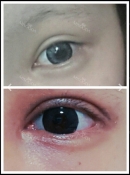 1 Week new eyes and nose with no bruise ><